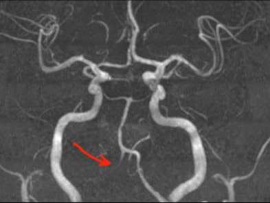 Магнито-резонансная ангиография позвоночной артерии