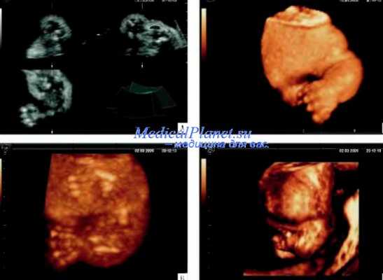 признаки танатоформной дисплазии