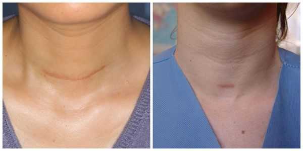 Рубец после традиционной операции открытым доступом и рубец после операции с мини-доступом