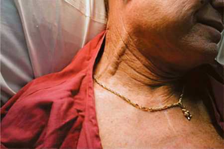 Тромбоз внутренней яремной вены