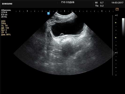 Мочевой пузырь - уретероцеле, B-режим (эхограмма №728)