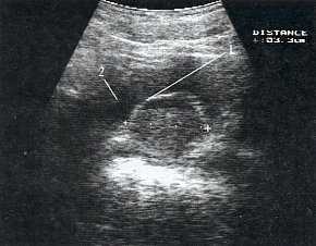УЗИ: уретероцеле рудиментарного мочеточника