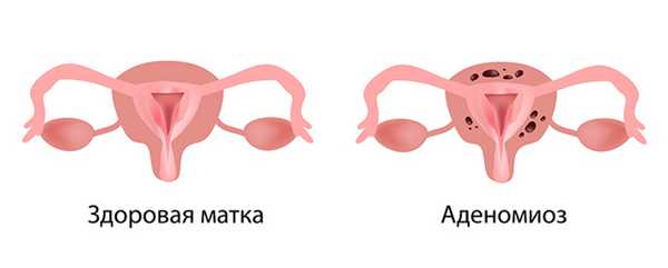 аденомиоз.jpg