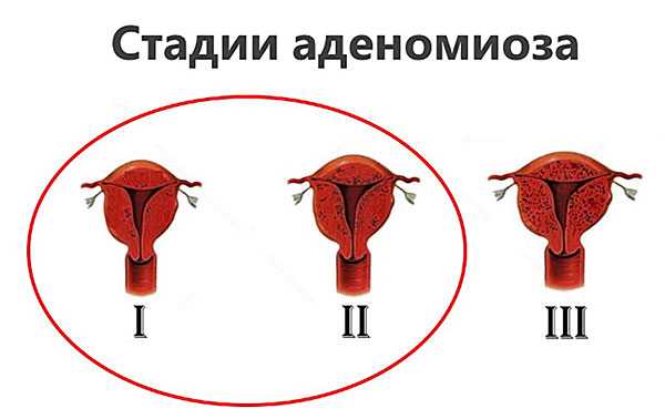 стадии аденомиоз.jpg