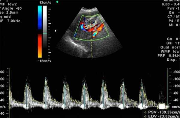 узи плода с доплером