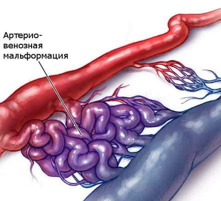 Расширение связей между артерией и веной приводит к развитию мальформации