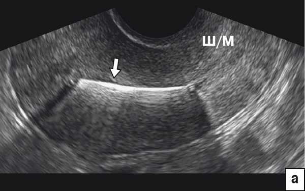 Гиперэхогенная картина стержня ВМС (стрелка) в проекции полости матки