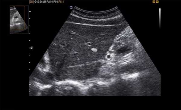 узи при холецистите