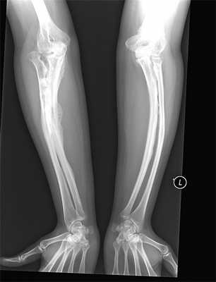 Несовершенный остеогенез