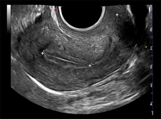 узи шейки матки фото