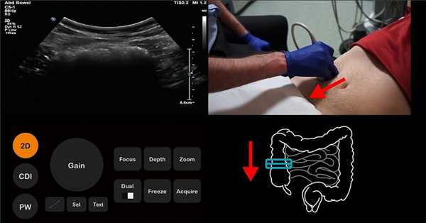 Далее передвигаем датчик вниз от восходящей ободочной кишки