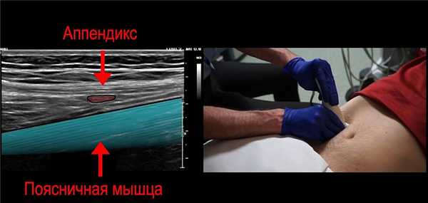 Полезный анатомический ориентир - поясничная мышца
