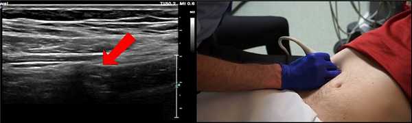 Важный ориентир. Мы видим, как терминальная часть подвздошной кишки входит в слепую кишку