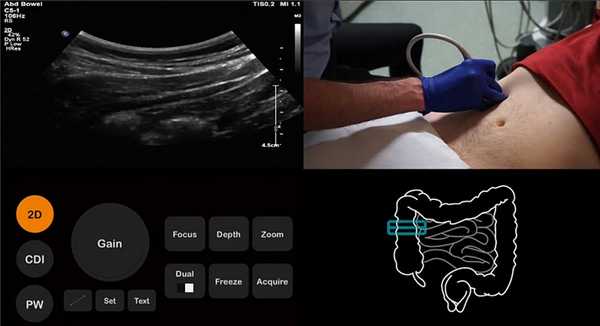 Аппендикс локализуется в подвздошной ямке