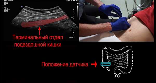 Найти терминальный отдел подвздошной кишки важно, потому что в нем могут идти патологические процессы