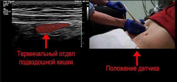 Терминальная подвздошная кишка должна иметь нормальную толщину стенки
