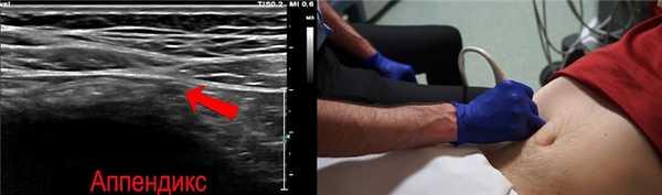 Мы нашили небольшую трубчатую структуру. Это и есть аппендикс