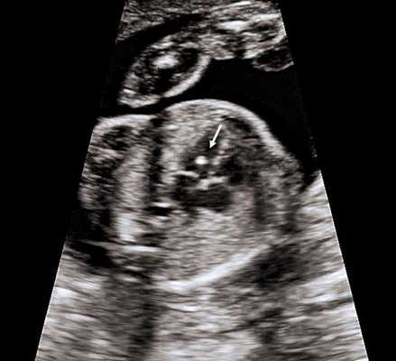 Гиперэхогенный фокус в желудочке сердца