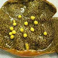 Холестероз