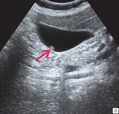 Эхограмма - одиночный полип в желчном пузыре (2б)