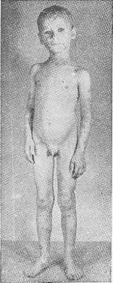 Prurigo Besnier у 6-летнего мальчика