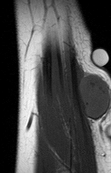 Узелковый фасциит