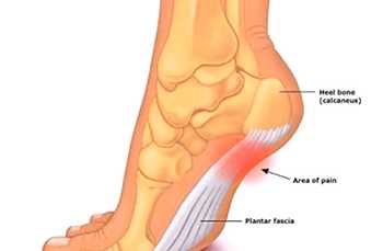 Подошвенный фасциит