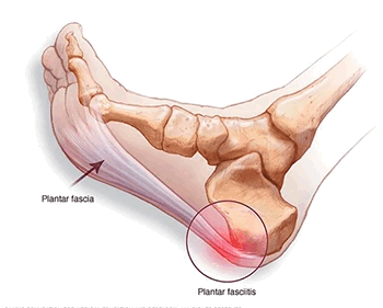 Узелковый фасциит