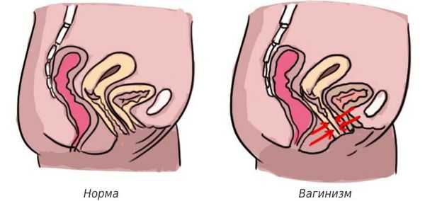 Спазм мышц при вагинизме