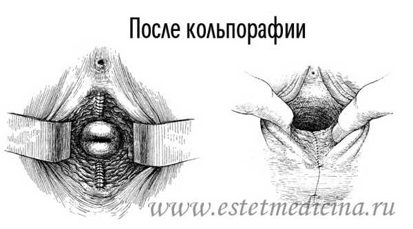 После кольпорафии - пластики влагалища