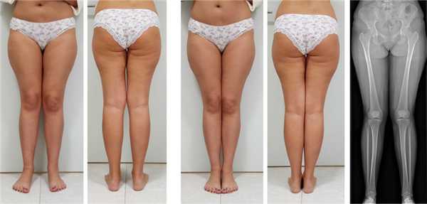 ноги Х образные, вальгусная деформация ног