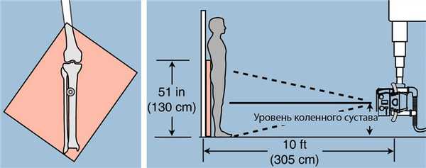 как сделать снимок обеих ног на обычном рентгене