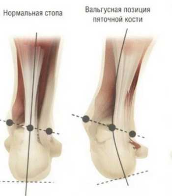 Вальгусная позиция пяточной кости