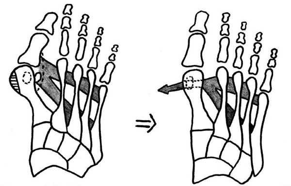 Схема операции МакБрайда