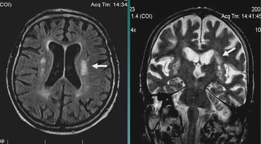 МРТ в диагностике нарушений мозгового кровообращения