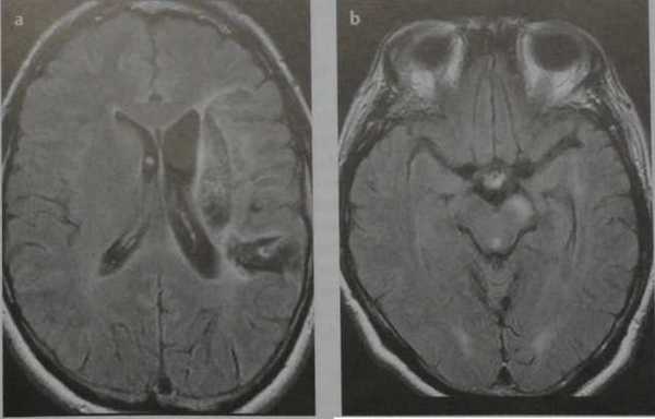 Снимки МРТ и КТ. Валлеровская дегенерация
