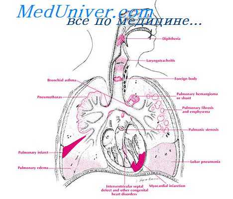 эозинофильное воспаление