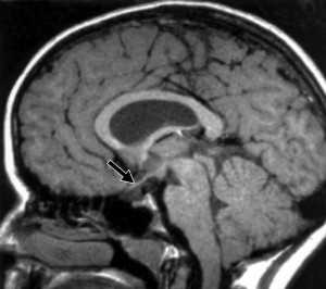 gsepto_optic_dysplasia_fig1b