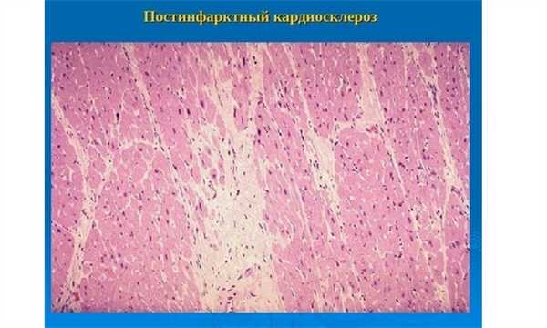 Постинфарктный кардиосклероз