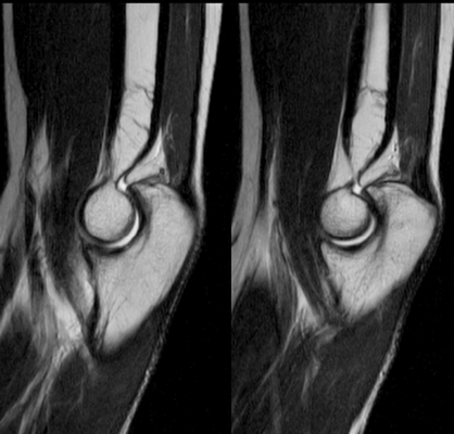 МР-томографии локтя