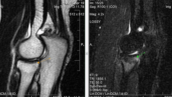 синовит на мрт локтя