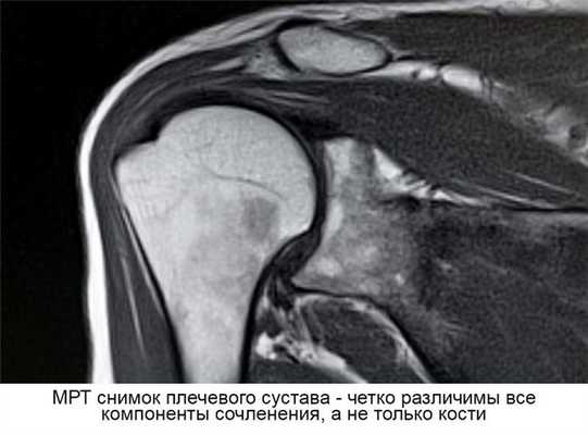 Снимок МРТ плеча