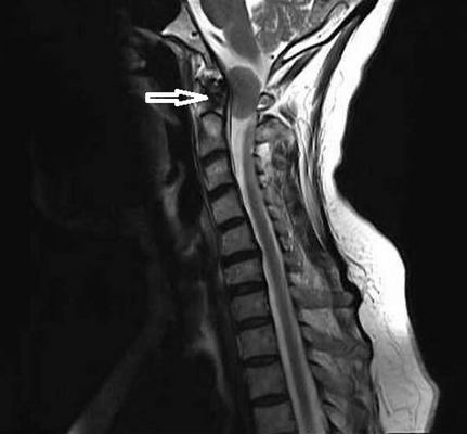 Опухоль краниовертебральной области