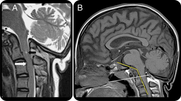 МРТ краниовертебрального перехода 