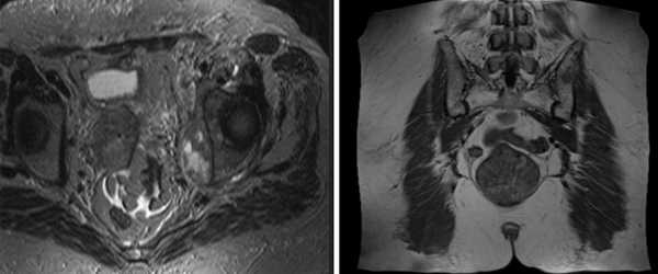 МРТ костей таза показывает множественные очаги, что говорит о метастатическом поражении 