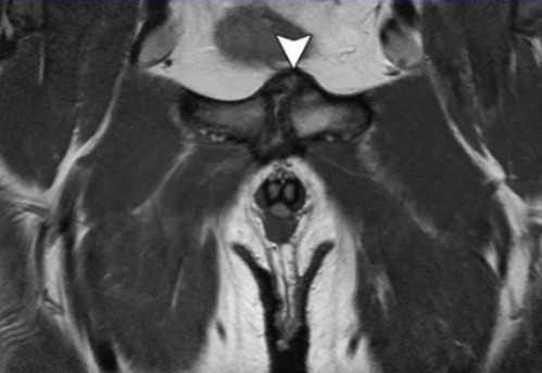 МРТ костей таза, что показывает