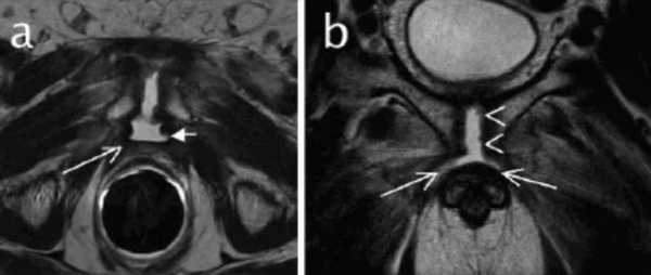 МРТ-признаки остеомиелита лонных костей