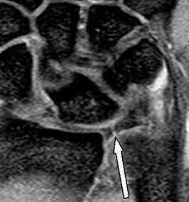 разрыв связки
