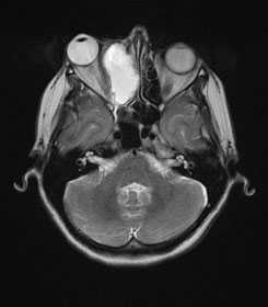 Похожая внешне на опухоль носа мукоцеле в полости глазницы и носа визуализируется на МРТ.
