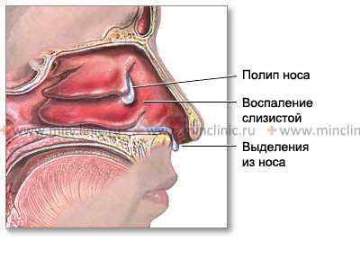 Иногда злокачественные опухоли носа по внешнему виду напоминают типичные доброкачественные — ангиому, папиллому или полип, изредка они схожи с буллой.